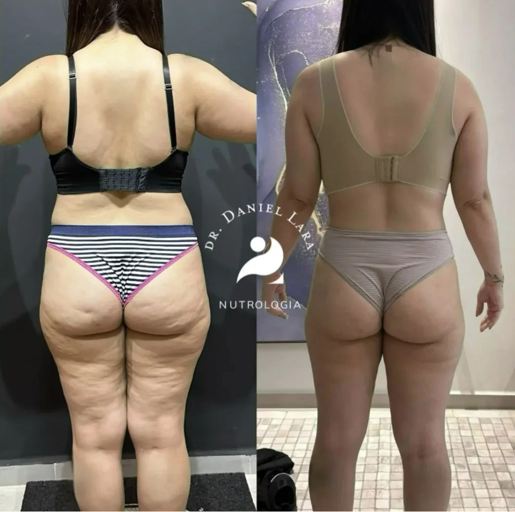 Paciente antes e depois do tratamento de emagrecimento com Dr. Daniel Lara