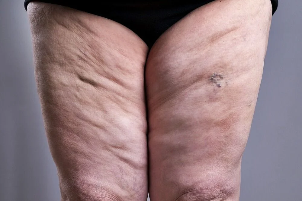 LIPEDEMA